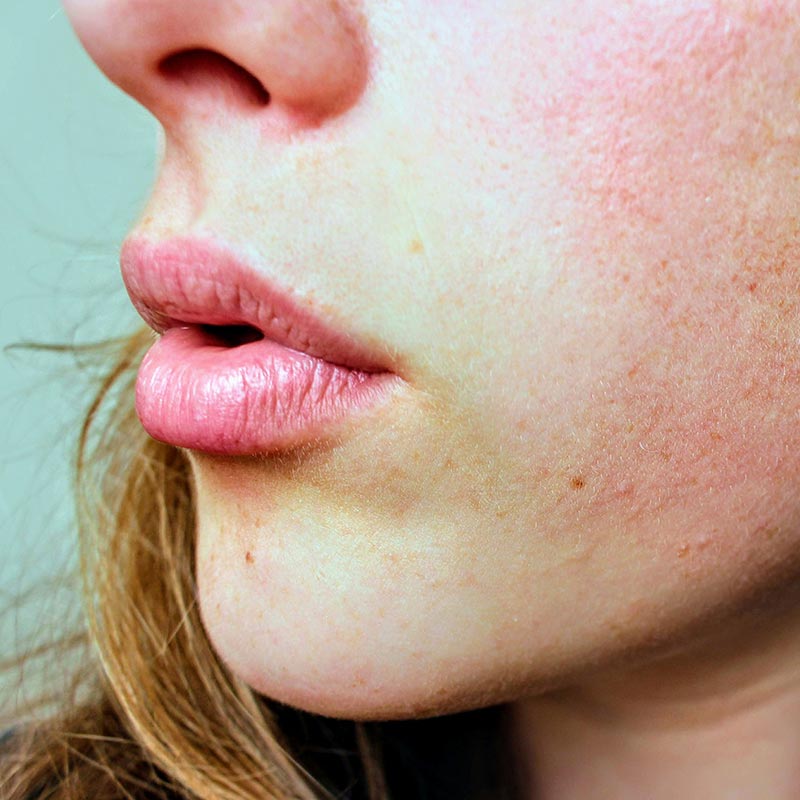 dermal filler